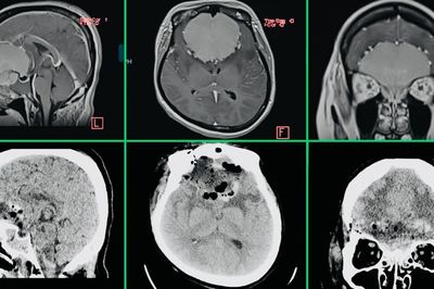 Mờ mắt tăng dần, không ngờ có khối u màng não khổng lồ