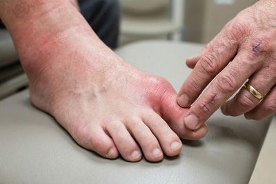 Cùng mắc gút cấp tái phát nhiều đợt, vì sao hai bệnh nhân lại có phác đồ điều trị khác nhau?