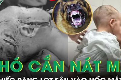 Bé trai 2 tuổi bị chó cắn nát vùng mặt