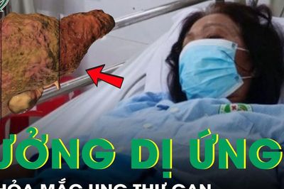 Ngứa 2 chân tưởng dị ứng, tá hỏa phát hiện mắc ung thư gan