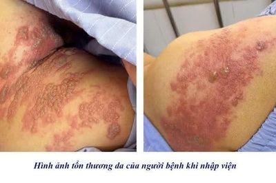 Tưởng zona ngoài da, cụ ông 78 tuổi bất ngờ mắc viêm màng não