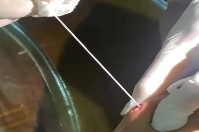 Ghi nhận trường hợp người đàn ông mắc giun rồng thứ 44 tại Việt Nam