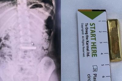 Bé gái 5 tuổi nuốt thỏi vàng dài 4cm vào bụng