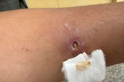 Nặn mụn trên cánh tay, người đàn ông 49 tuổi phát hiện giun rồng 20cm làm tổ