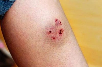 Bệnh dại ở TP.HCM tăng 92%, đã có 23 người không qua khỏi