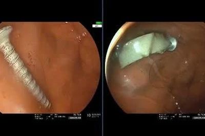 Bé gái 11 tháng tuổi suy hô hấp vì nuốt đinh vít dài 4 cm vào dạ dày