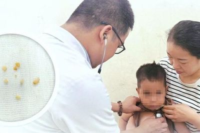 Cứu sống bé trai 2 tuổi hóc hạt lạc, bít kín hai bên phế quản
