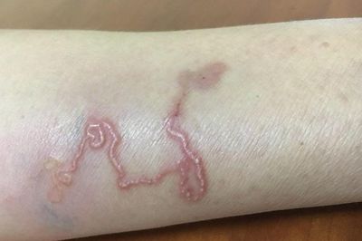 Loại giun có thể ngủ quên hàng chục năm rồi bất ngờ bùng phát