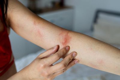 6 dấu hiệu cảnh báo tình trạng dị ứng nghiêm trọng