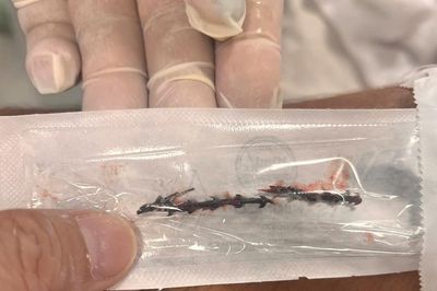 Bệnh viện Đà Nẵng gắp thành công dị vật dài 11cm có nhiều gai ngược trong phế quản bệnh nhân