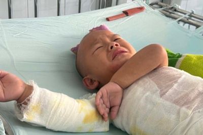MS 1108: Bé trai dân tộc H'Mông 3 tuổi bị bỏng nặng cần sự giúp đỡ