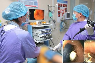 Nuốt nguyên viên thuốc còn vỏ, người đàn ông 60 tuổi phải cấp cứu vì dị vật mắc ở thực quản