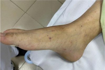 Căn bệnh có thể không qua khỏi trong 24 giờ: Ai dễ mắc?