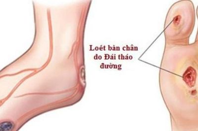 Tê rần bàn chân ở người tiểu đường cần chú ý biến chứng thần kinh