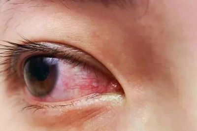 Đau mắt đỏ thường gặp trong mùa mưa, có thể bùng phát thành dịch