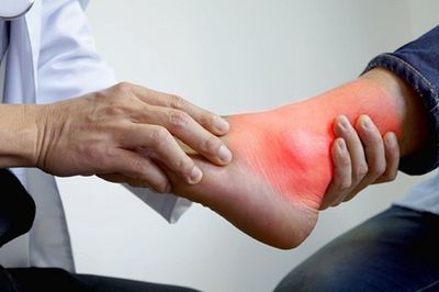 Chủ quan với đau khớp chân, thanh niên 20 tuổi ngỡ ngàng khi phát hiện mắc gout