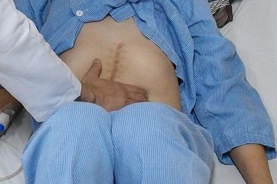 Từ một dấu hiệu lạ, phát hiện mắc cùng lúc ung thư trực tràng và phổi