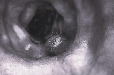 Phát hiện khối u ác tính và 39 polyp đại tràng từ một biểu hiện lạ