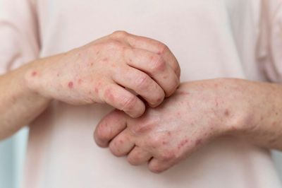 Mắc thủy đậu rồi có mắc lại lần hai không?