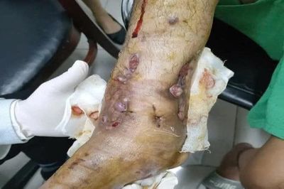 Suýt phải cắt chân sau nhiều lần phẫu thuật vì bỏ sót lao xương