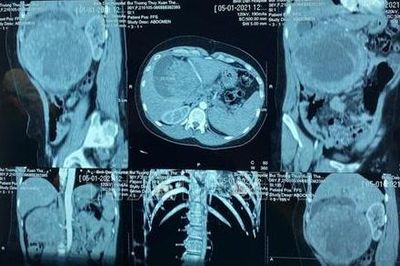 Mỹ phê duyệt thuốc điều trị ung thư tuyến tụy di căn