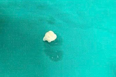 Bà nhổ răng cho cháu bằng sợi chỉ, bé trai 7 tuổi nguy kịch