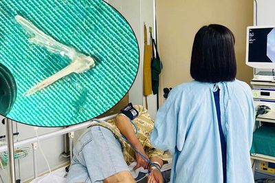 Xương ghẹ chắn ngang thực quản cụ ông 81 tuổi