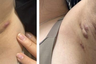 Viêm tuyến mồ hôi mủ dễ nhầm với mụn nhọt, áp xe