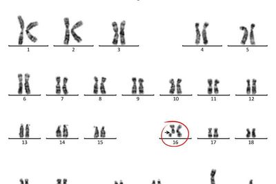 Khám tiền sinh sản, nam thanh niên bất ngờ phát hiện nhiễm sắc thể bất thường