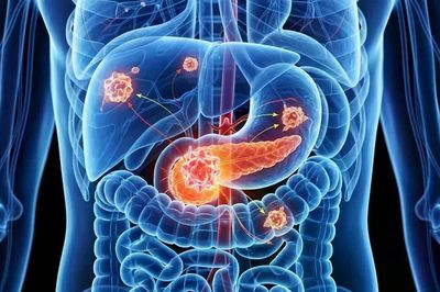 Mỹ phê duyệt thuốc điều trị ung thư tuyến tụy di căn