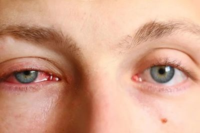 Mùa mưa, đau mắt đỏ dễ lây lan: 6 thói quen tưởng vô hại nhưng nên bỏ ngay