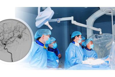 Hai trẻ vỡ dị dạng mạch máu não được can thiệp nội mạch thành công
