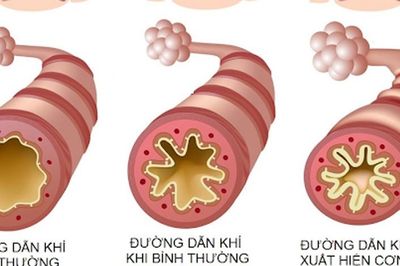 Phòng tránh cơn hen cấp lúc giao mùa