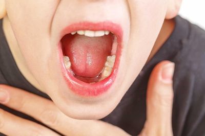 Triệu chứng viêm VA cấp tính và mạn tính ở trẻ em