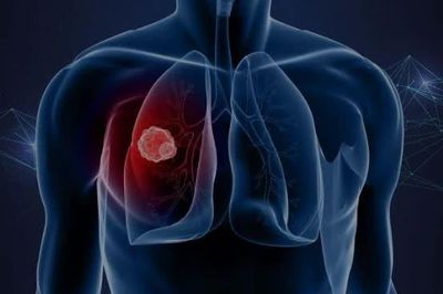 Phát hiện sớm, chẩn đoán chính xác để nâng cao hiệu quả điều trị ung thư phổi