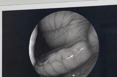 Chảy máu mũi kéo dài một tháng, nam thanh niên bất ngờ phát hiện đỉa trong khoang mũi