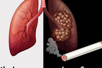70-80% bệnh nhân ung thư phổi tại Việt Nam được chẩn đoán ở giai đoạn muộn