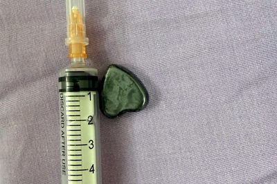 Bé trai 15 tháng tuổi nuốt cục nam châm hình trái tim, bác sĩ khẩn cấp can thiệp trong đêm