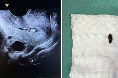 Phát hiện polyp buồng tử cung trước IVF, khi nào cần cắt?