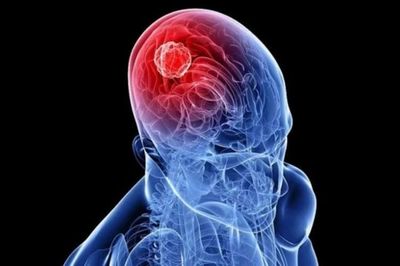 Nhận biết dấu hiệu u não để tránh biến chứng nguy hiểm