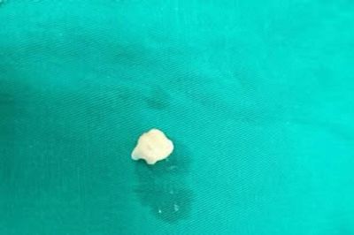 Nhổ răng tại nhà, bé trai nguy kịch vì răng rơi xuống phế quản gây xẹp phổi
