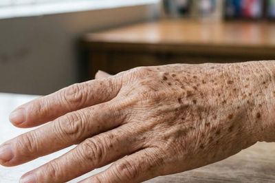 Đốm đồi mồi, có nên dùng nước cốt chanh để làm mờ?