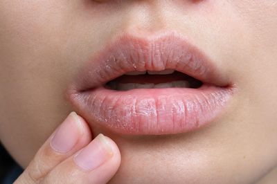 Dưỡng môi chăm chỉ nhưng miệng vẫn khô như sa mạc: Dấu hiệu 4 bệnh lý