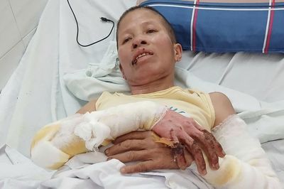 Mẹ vừa qua đời, người phụ nữ đơn thân bị bỏng nặng khi cúng cơm