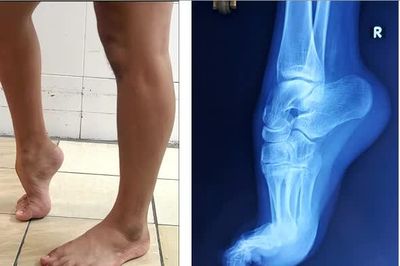 Phẫu thuật thành công ca dị tật 'bàn chân thuổng' bẩm sinh phức tạp