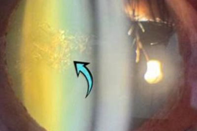 Phát hiện bệnh hiếm hình 'cây thông Noel' trong mắt người phụ nữ 70 tuổi