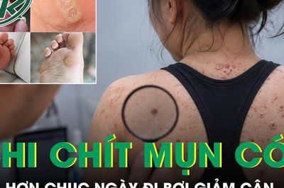 Cô gái mọc mụn cóc khắp người sau hơn chục ngày đi bơi giảm cân