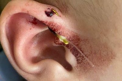 Lưỡi câu móc vào vành tai bé 10 tháng tuổi
