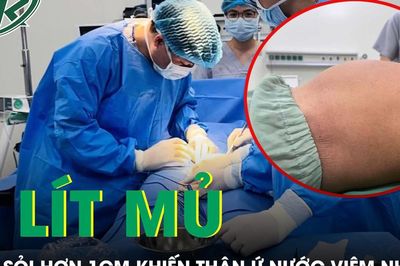 Viên sỏi hơn 1cm suýt phá hỏng quả thận người đàn ông