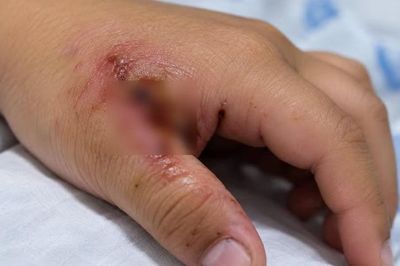 Uốn ván nặng, bé trai 7 tuổi co giật liên tục